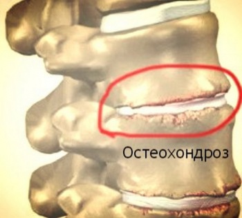 Фото к статье Как облегчить симптомы шейного остеохондроза 3.jpg